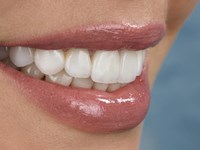 ¿Cuáles son los tratamientos de estética dental más comunes?