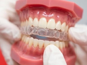 Cómo corregir los espacios entre los dientes sin ortodoncia