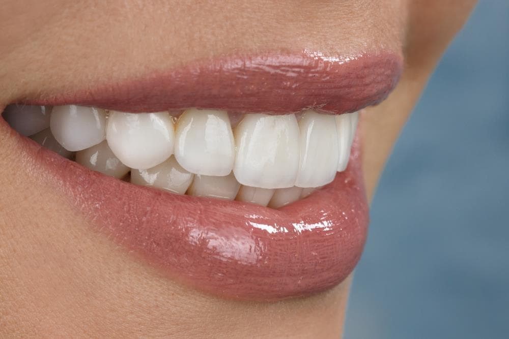 ¿Cuáles son los tratamientos de estética dental más comunes?