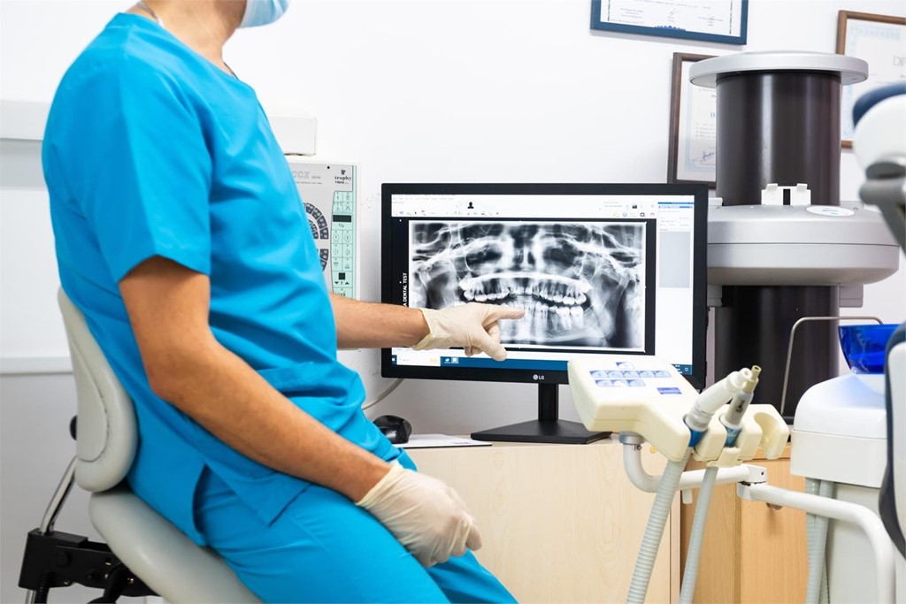 ¿Cuándo son recomendables los implantes dentales?