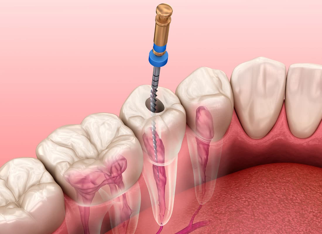 Tratamiento de endodoncia en Lugo