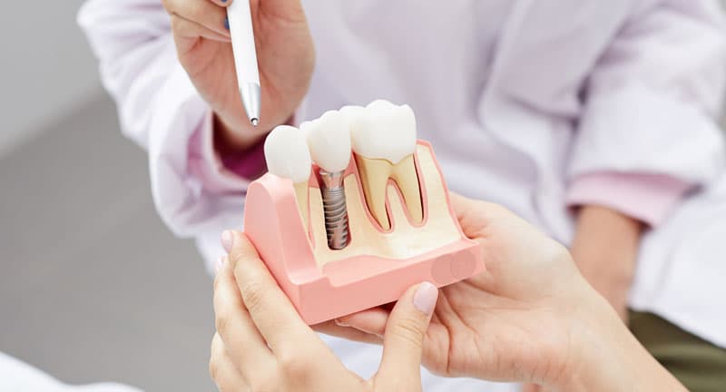 Implantes dentales en Lugo