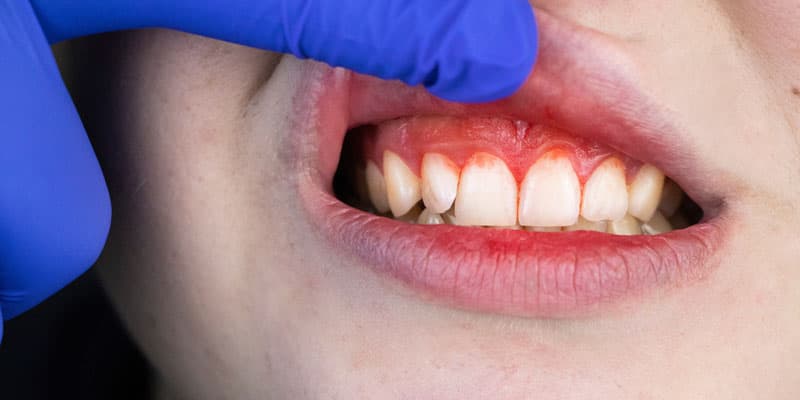 Tratar gingivitis en Lugo