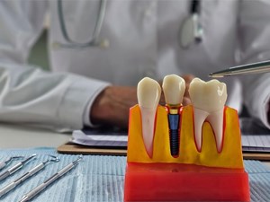 Mejora tu calidad de vida: los implantes dentales te devuelven la seguridad al comer y sonreír