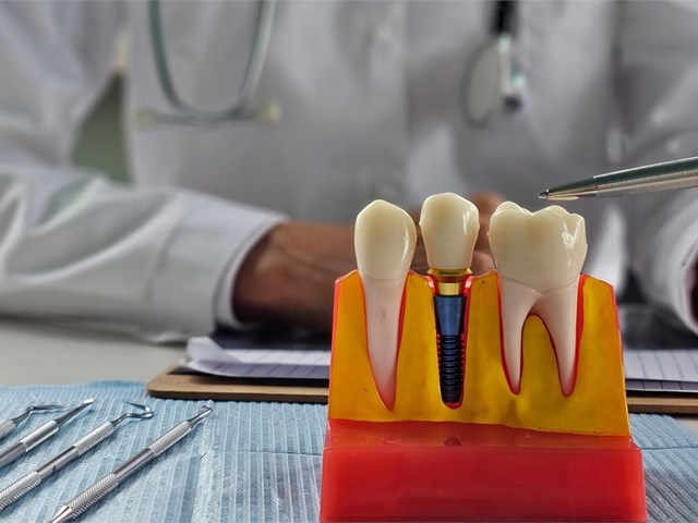 Mejora tu calidad de vida: los implantes dentales te devuelven la seguridad al comer y sonreír