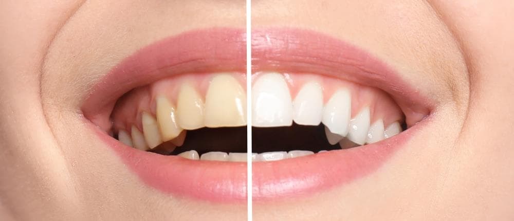 Sonrisa brillante: Conoce los beneficios y el proceso del blanqueamiento dental