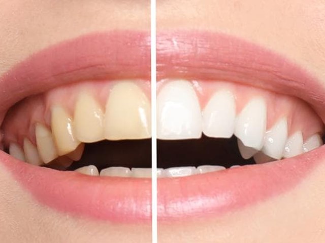 Sonrisa brillante: Conoce los beneficios y el proceso del blanqueamiento dental